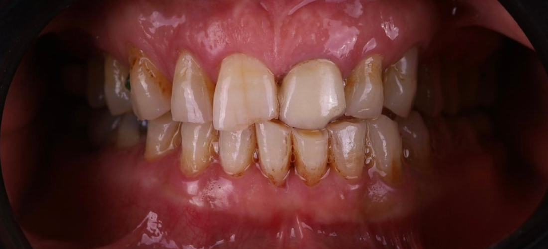 قشور الأسنان2