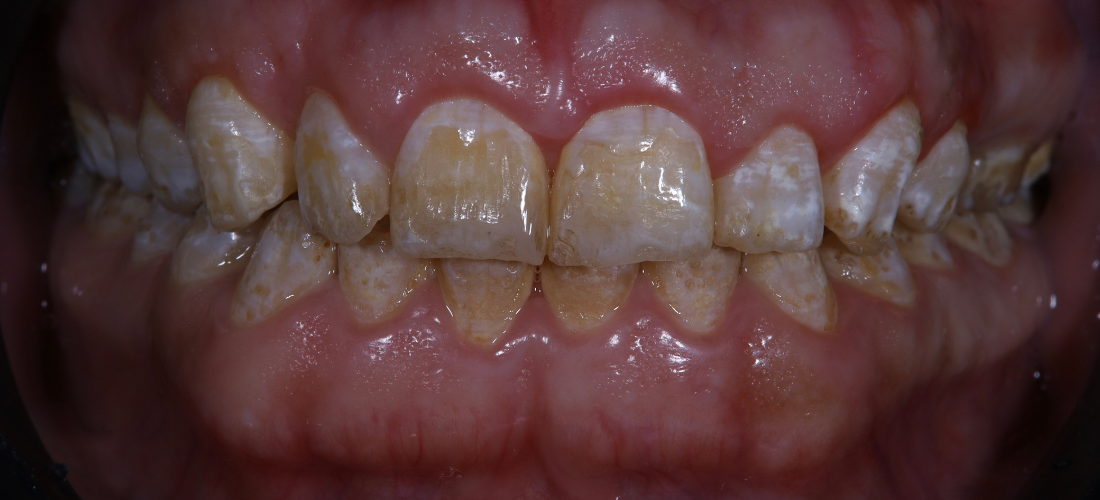 إطالة التاج